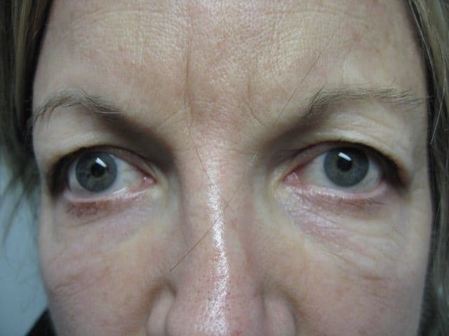 Image of Eyelid Tightening Blepharoplasty Preop by Rhode Island  Plastic Surgery excellence