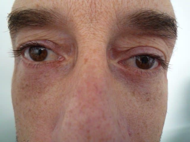Image of post op Blepharoplasty Eyelid tightening with perfect results and non-visible scar by Best R.I. Plastic Surgeon