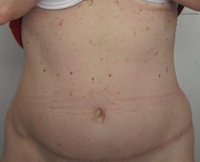 image of amazing best contour post abdominoplasty tummy tuck mommy make over surgery 