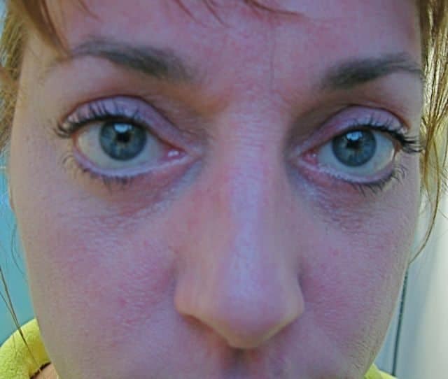 Image of post op Blepharoplasty Eyelid tightening with perfect results and non-visible scar by Best R.I. Plastic Surgeon