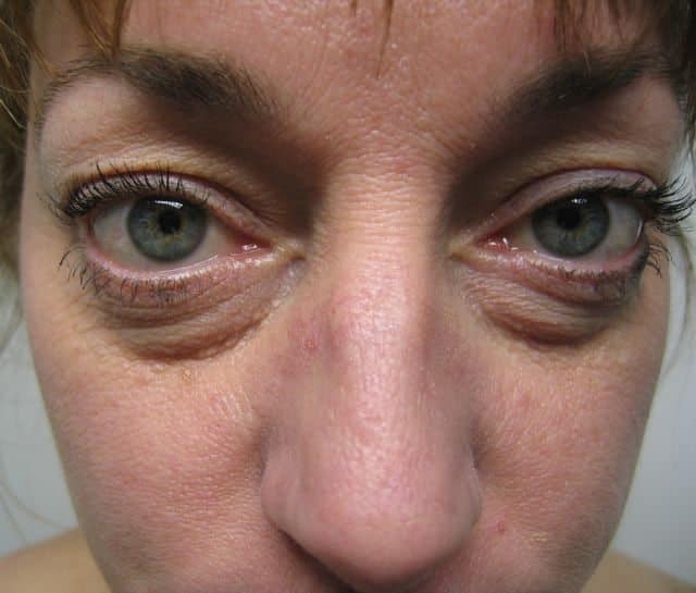 Image of Eyelid Tightening Blepharoplasty Preop by Rhode Island  Plastic Surgery excellence