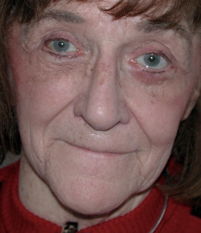 Image of post op Blepharoplasty Eyelid tightening with perfect results and non-visible scar by Best R.I. Plastic Surgeon