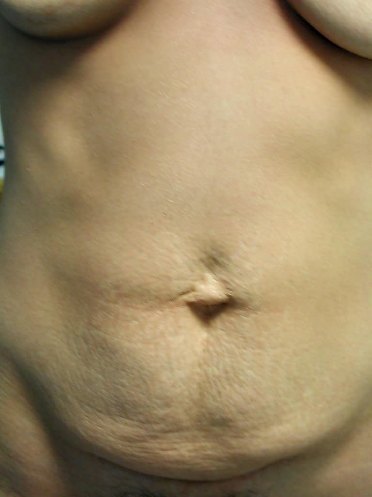 image of preop abdomioplasty tummy tuck mommy make over surgery by Dr. O'Sullivan 