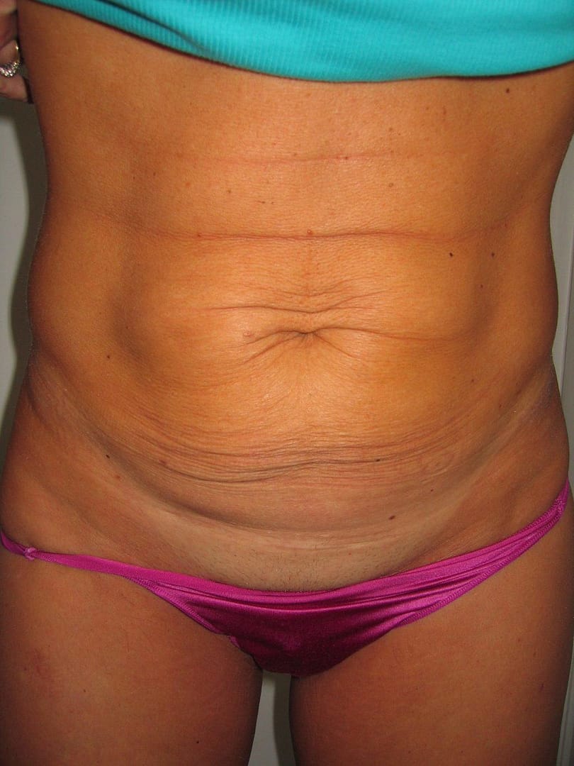 image of preop abdomioplasty tummy tuck mommy make over surgery by Dr. O'Sullivan 