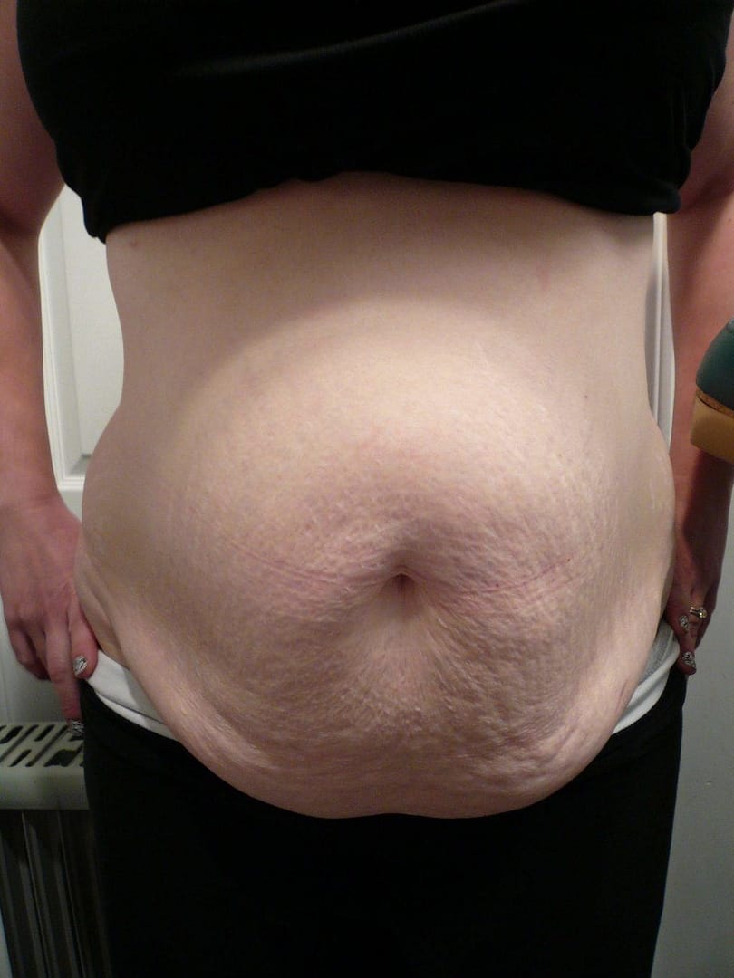 image of preop abdomioplasty tummy tuck mommy make over surgery by Dr. O'Sullivan 