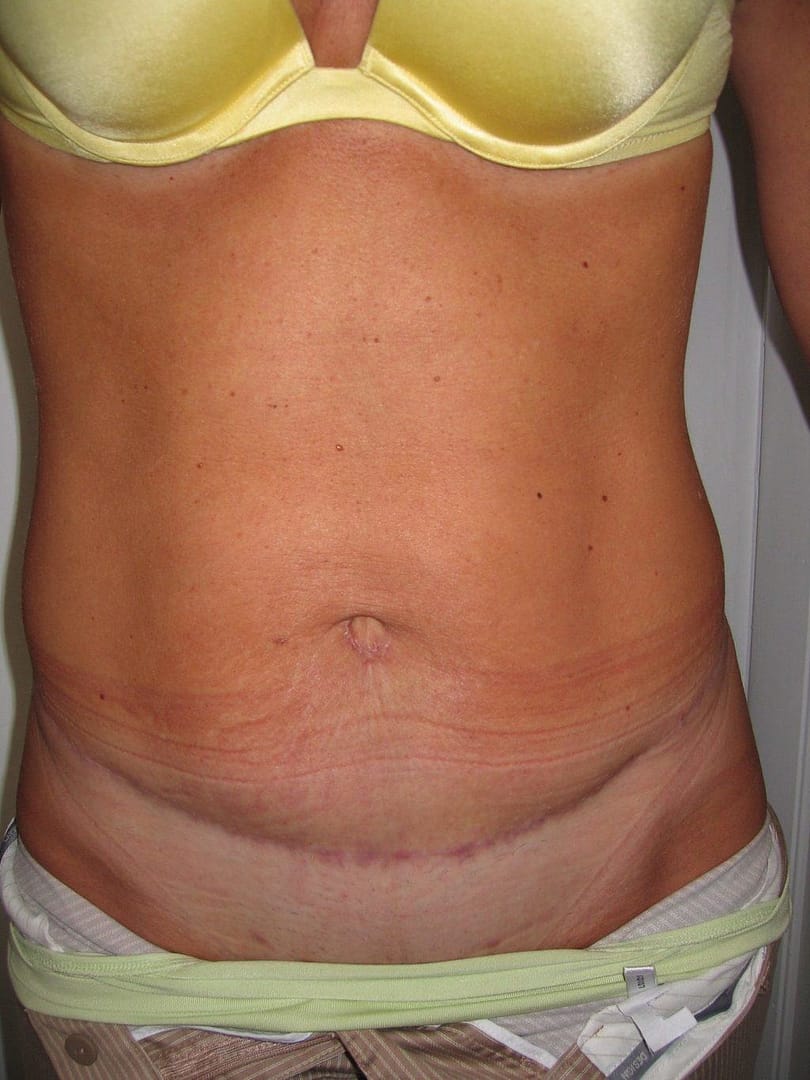 image of amazing best contour post abdominoplasty tummy tuck mommy make over surgery 