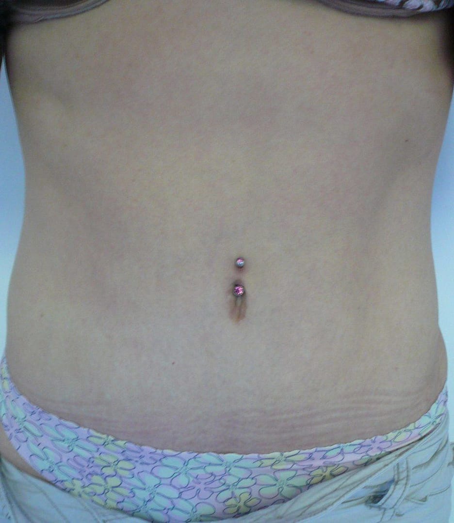 image of amazing best contour post abdominoplasty tummy tuck mommy make over surgery 