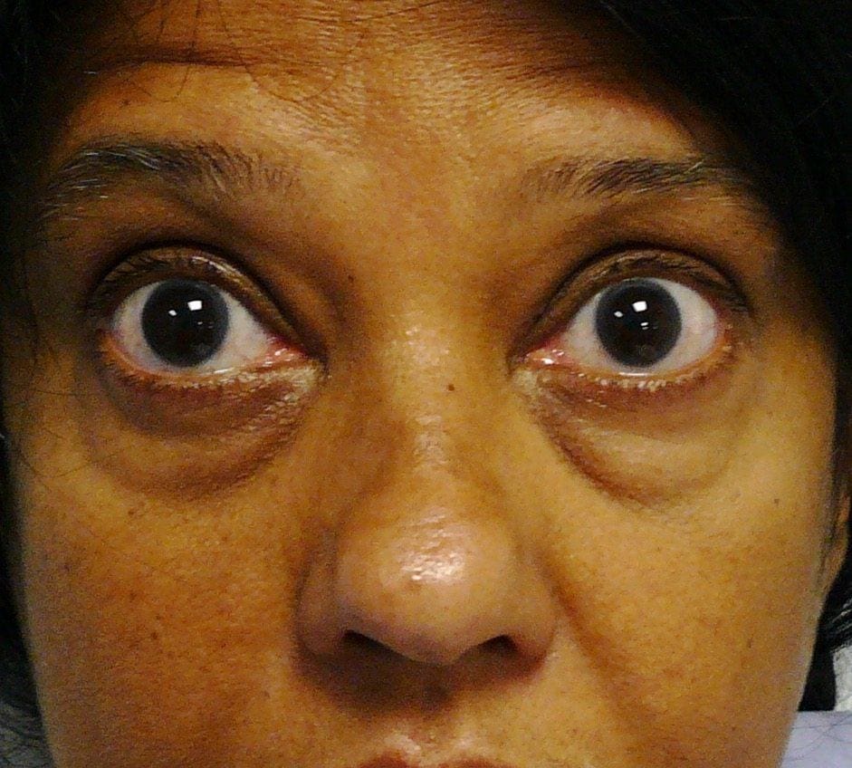 Image of Eyelid Tightening Blepharoplasty Preop by Rhode Island  Plastic Surgery excellence